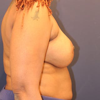 Breast Augmentation Before & After Gallery - Patient 174149971 - Image 6