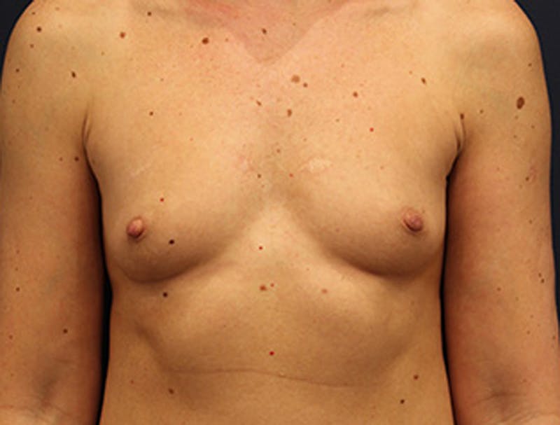 Breast Augmentation Before & After Gallery - Patient 174149979 - Image 1