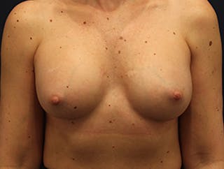 Breast Augmentation Before & After Gallery - Patient 174149979 - Image 2