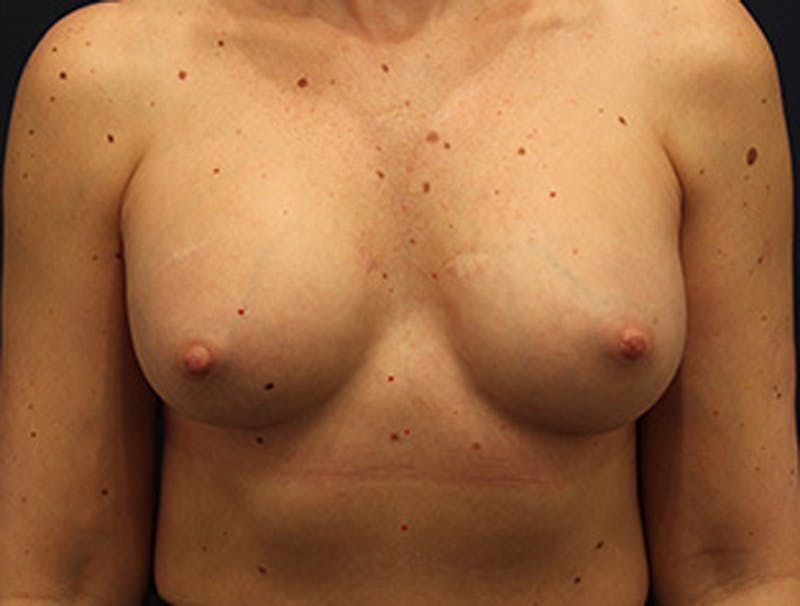 Breast Augmentation Before & After Gallery - Patient 174149979 - Image 2