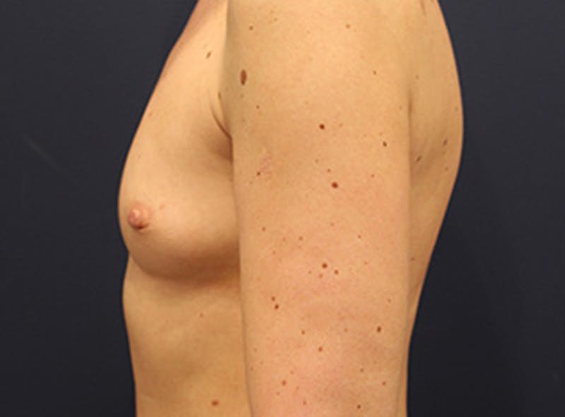 Breast Augmentation Before & After Gallery - Patient 174149979 - Image 5