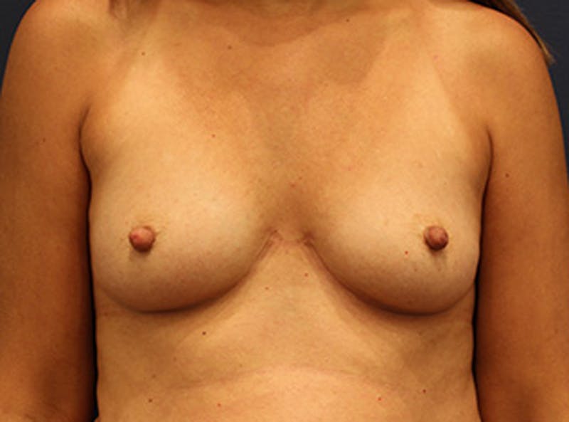 Breast Augmentation Before & After Gallery - Patient 174149983 - Image 1