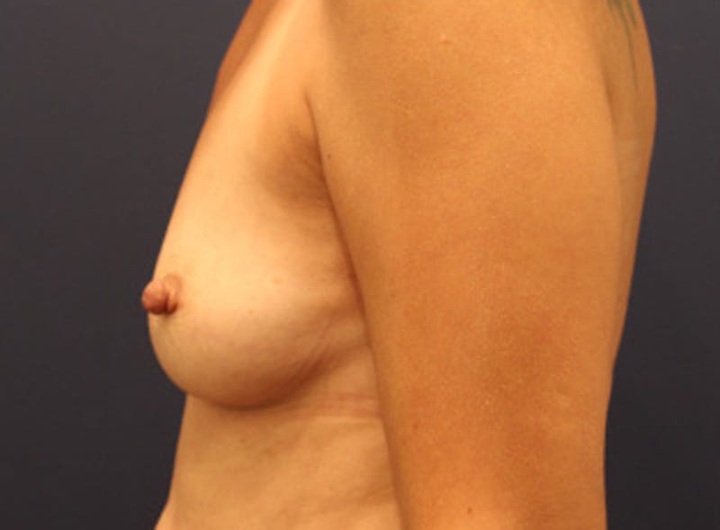 Breast Augmentation Before & After Gallery - Patient 174149983 - Image 5