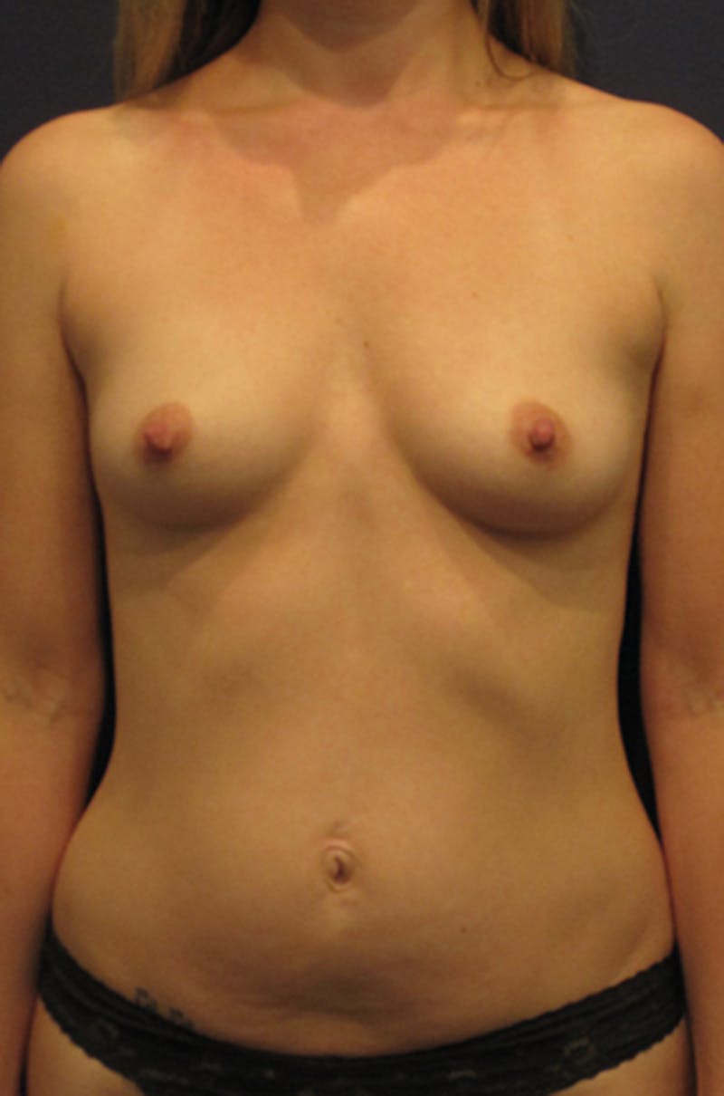 Breast Augmentation Before & After Gallery - Patient 174149997 - Image 1