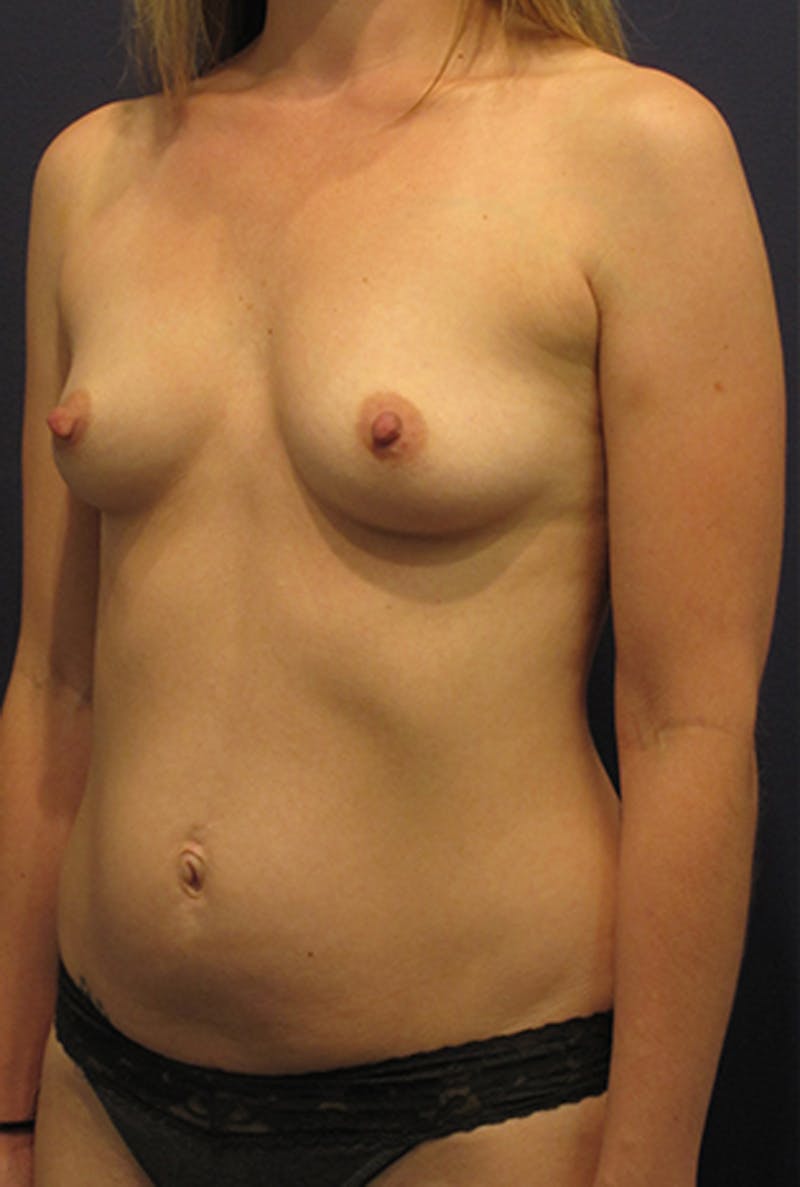 Breast Augmentation Before & After Gallery - Patient 174149997 - Image 3