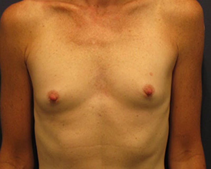 Breast Augmentation Before & After Gallery - Patient 174150006 - Image 1