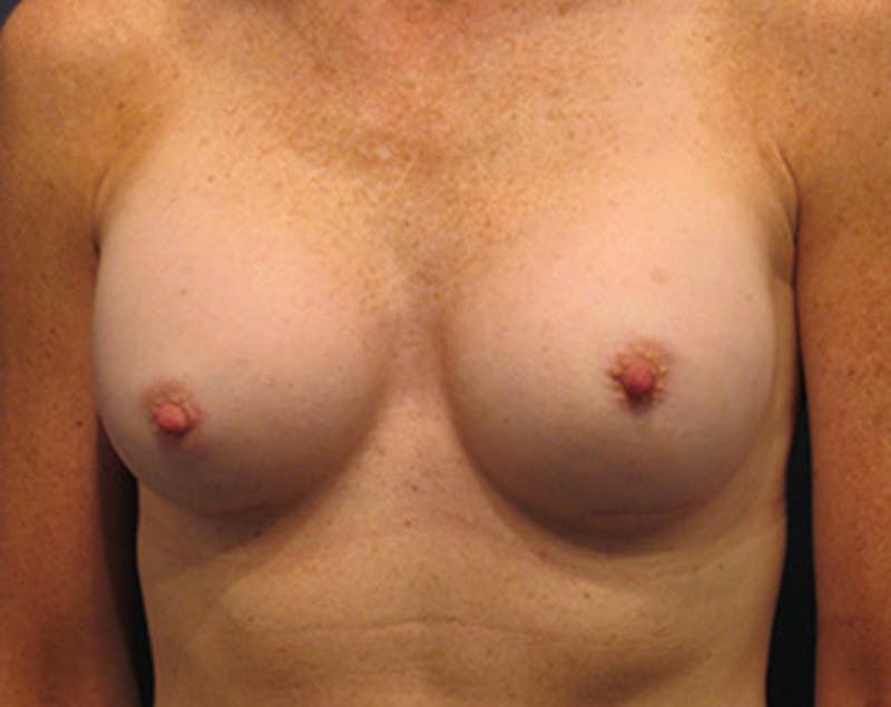 Breast Augmentation Before & After Gallery - Patient 174150006 - Image 2