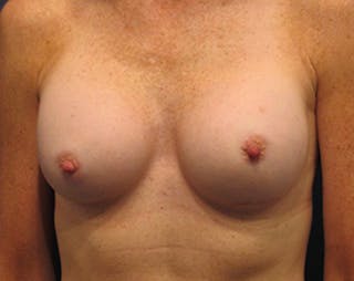 Breast Augmentation Before & After Gallery - Patient 174150006 - Image 2