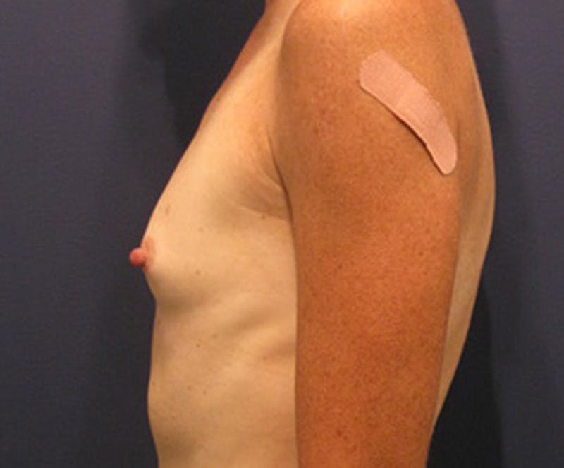 Breast Augmentation Before & After Gallery - Patient 174150006 - Image 3