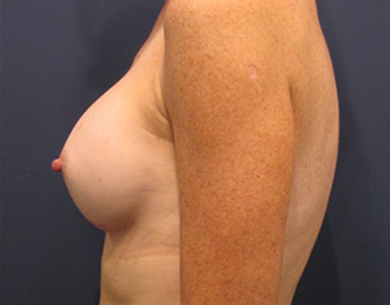 Breast Augmentation Before & After Gallery - Patient 174150006 - Image 4
