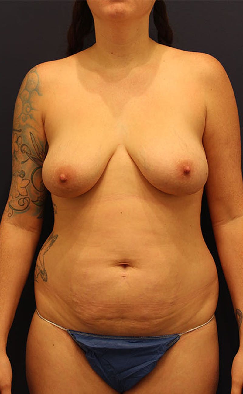 Breast Augmentation Before & After Gallery - Patient 174150010 - Image 1