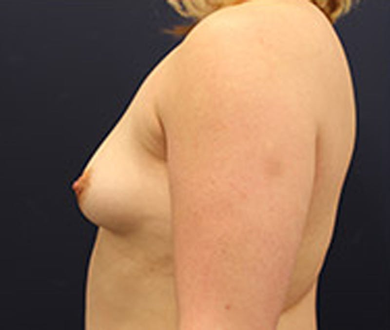 Breast Augmentation Before & After Gallery - Patient 174150013 - Image 5
