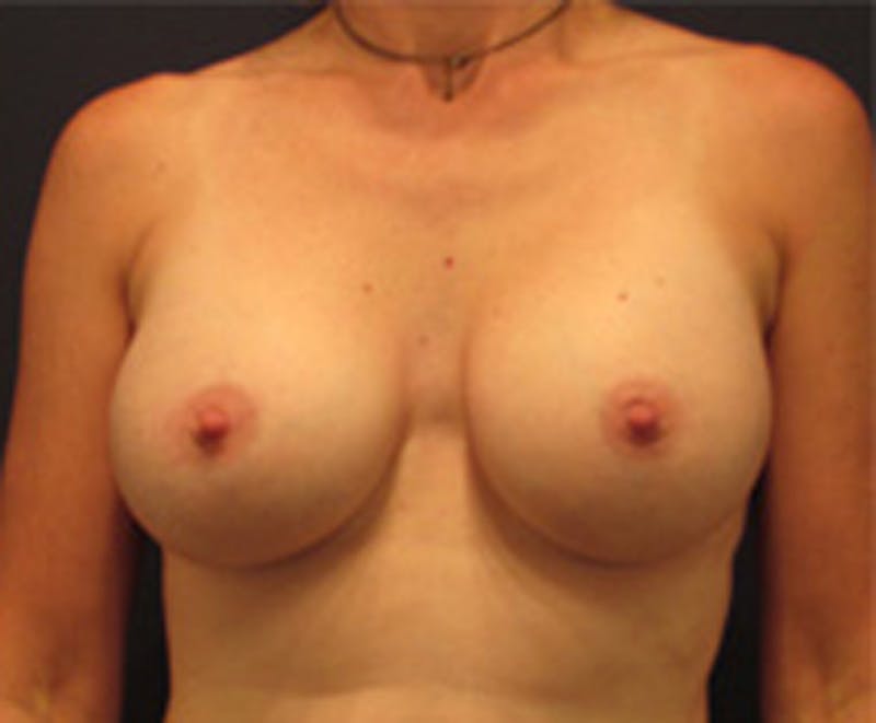 Breast Augmentation Before & After Gallery - Patient 174150017 - Image 1