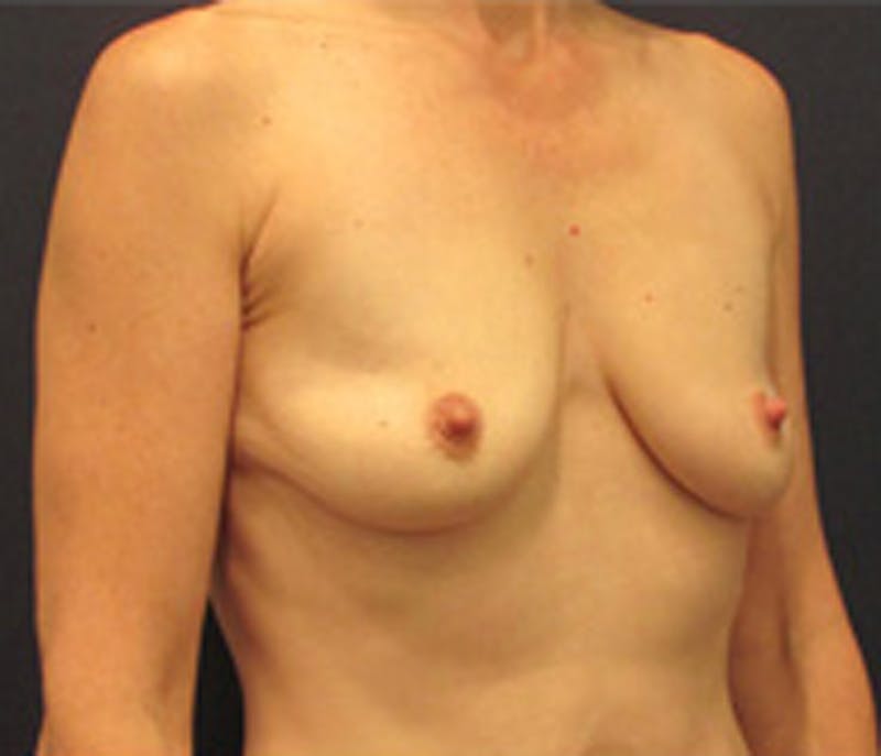 Breast Augmentation Before & After Gallery - Patient 174150017 - Image 3
