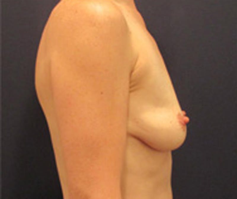 Breast Augmentation Before & After Gallery - Patient 174150017 - Image 5