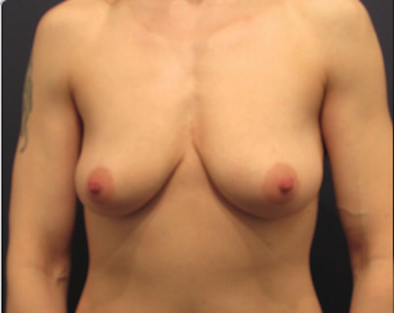 Breast Augmentation Before & After Gallery - Patient 174150022 - Image 1