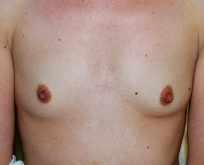 Breast Augmentation Before & After Gallery - Patient 174150028 - Image 1