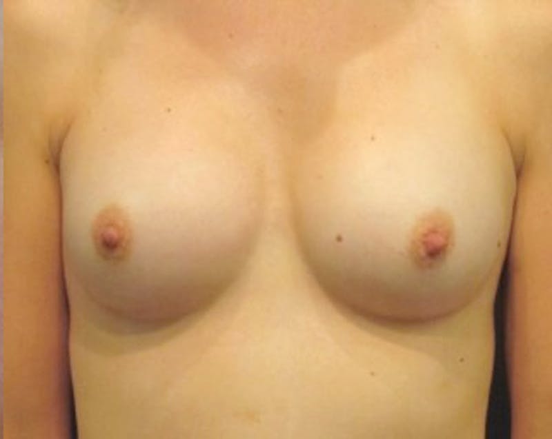 Breast Augmentation Before & After Gallery - Patient 174150028 - Image 2