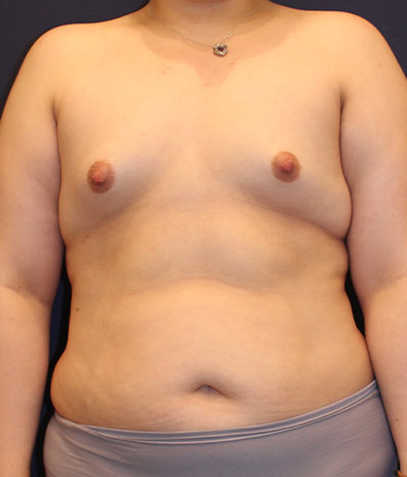 Breast Augmentation Before & After Gallery - Patient 174150032 - Image 1