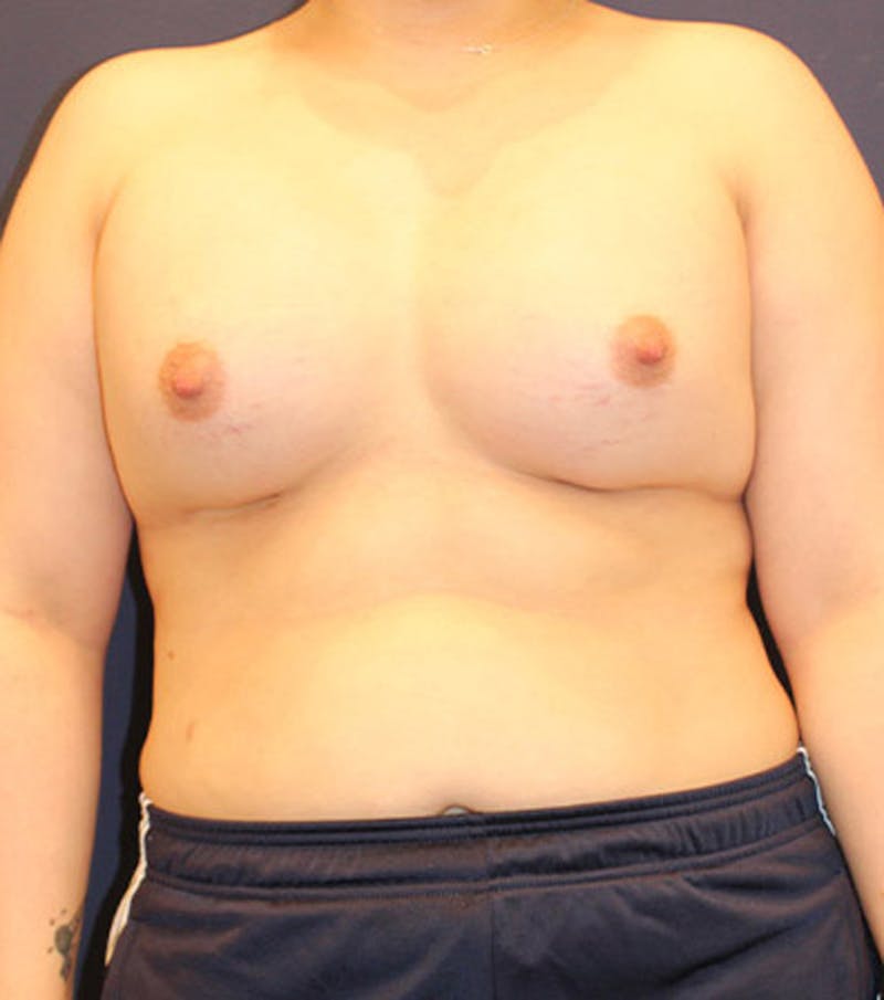 Breast Augmentation Before & After Gallery - Patient 174150032 - Image 2