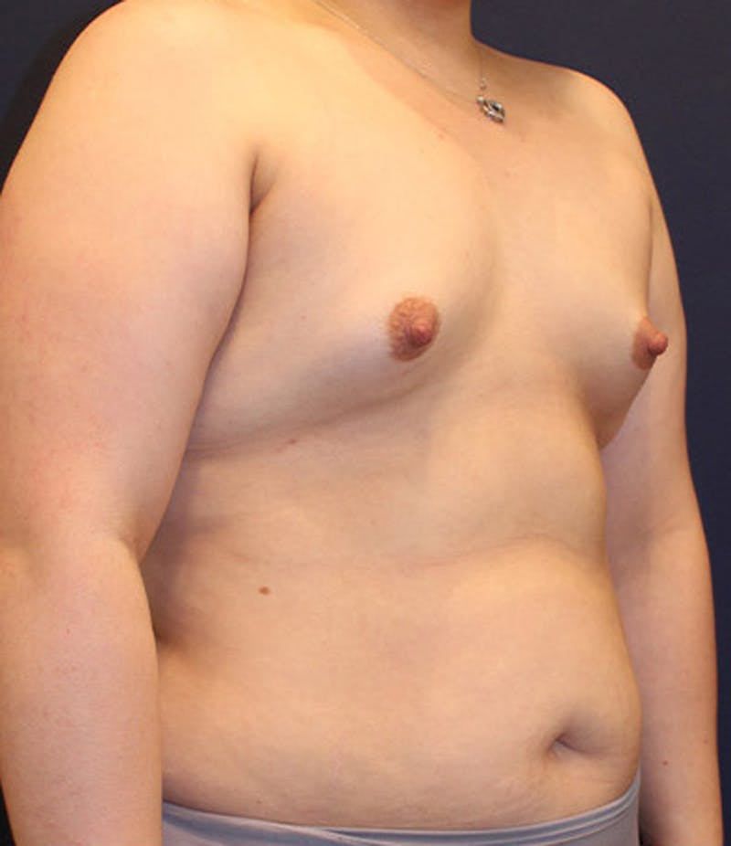 Breast Augmentation Before & After Gallery - Patient 174150032 - Image 3
