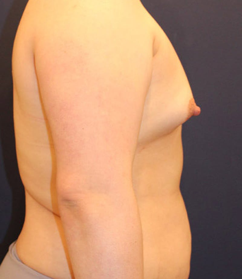 Breast Augmentation Before & After Gallery - Patient 174150032 - Image 5