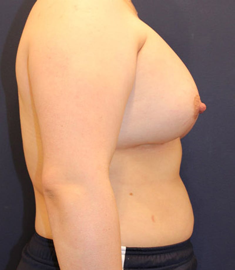 Breast Augmentation Before & After Gallery - Patient 174150032 - Image 6