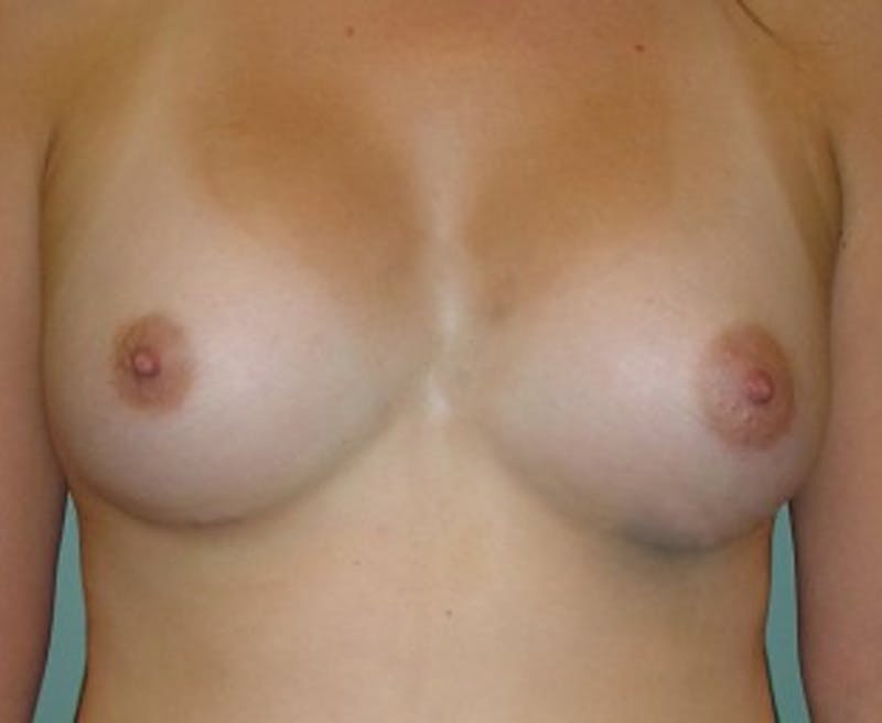 Breast Augmentation Before & After Gallery - Patient 174160036 - Image 2