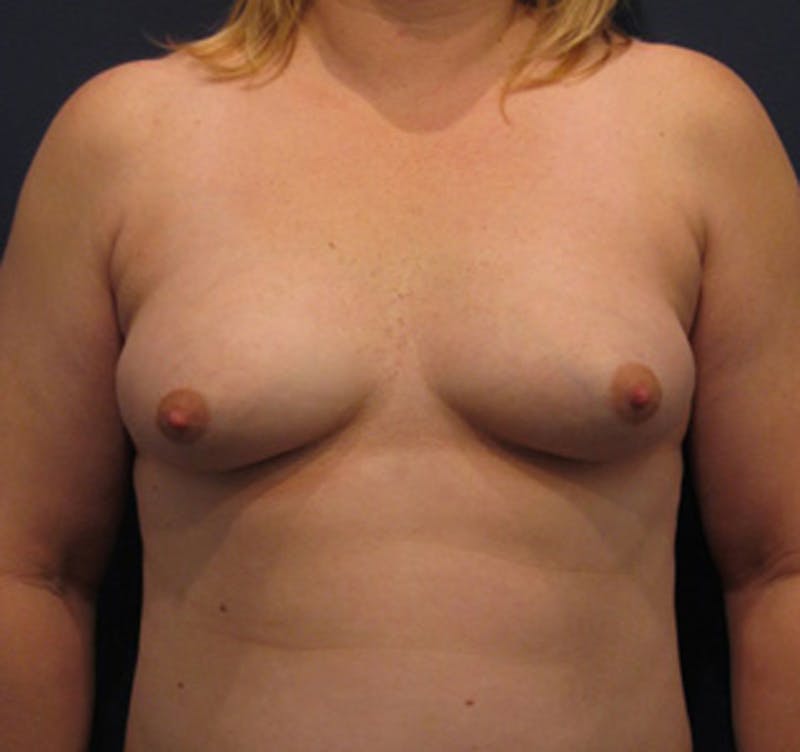 Breast Augmentation Before & After Gallery - Patient 174160946 - Image 1
