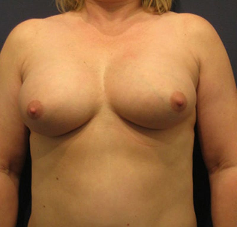 Breast Augmentation Before & After Gallery - Patient 174160946 - Image 2