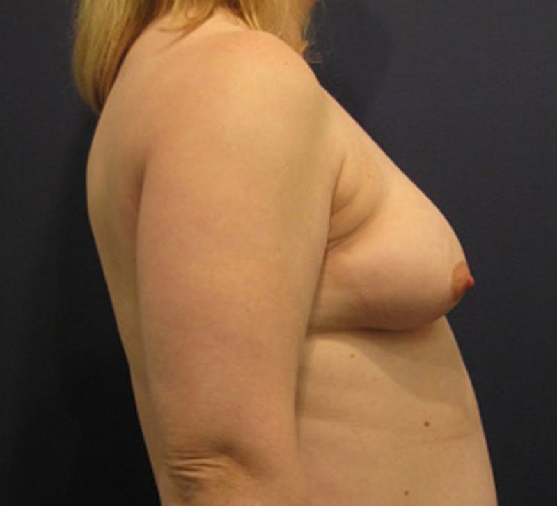 Breast Augmentation Before & After Gallery - Patient 174160946 - Image 3