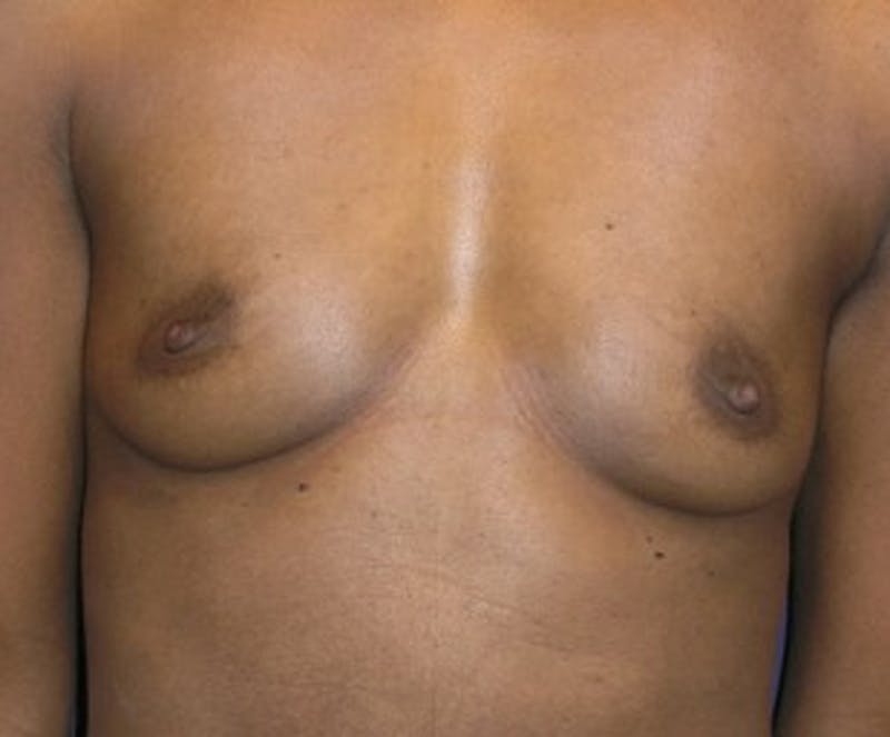 Breast Augmentation Before & After Gallery - Patient 174160950 - Image 1