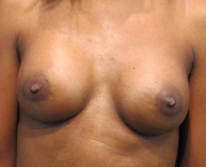 Breast Augmentation Before & After Gallery - Patient 174160950 - Image 2