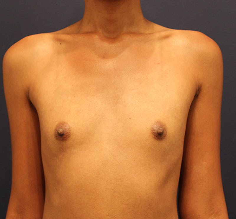 Breast Augmentation Before & After Gallery - Patient 174160960 - Image 1