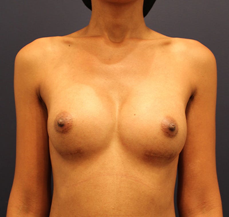 Breast Augmentation Before & After Gallery - Patient 174160960 - Image 2
