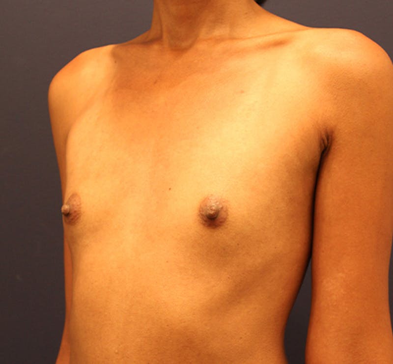 Breast Augmentation Before & After Gallery - Patient 174160960 - Image 3