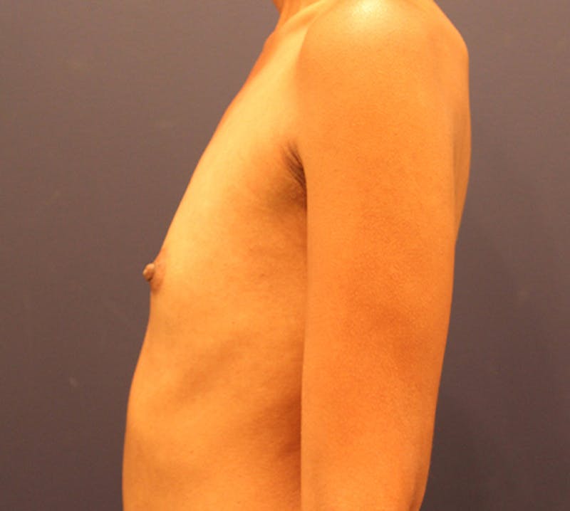 Breast Augmentation Before & After Gallery - Patient 174160960 - Image 5