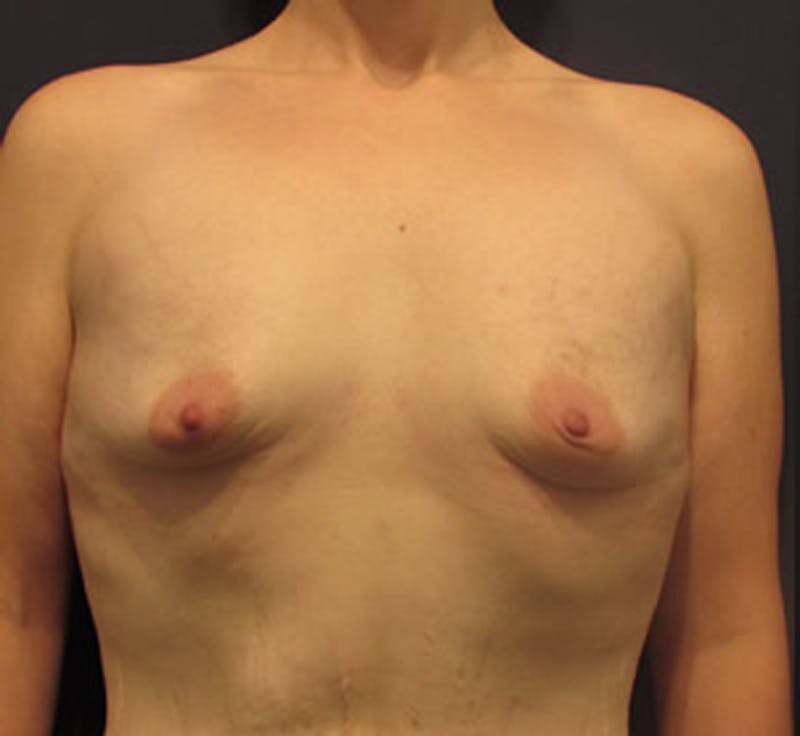 Breast Augmentation Before & After Gallery - Patient 174160967 - Image 1