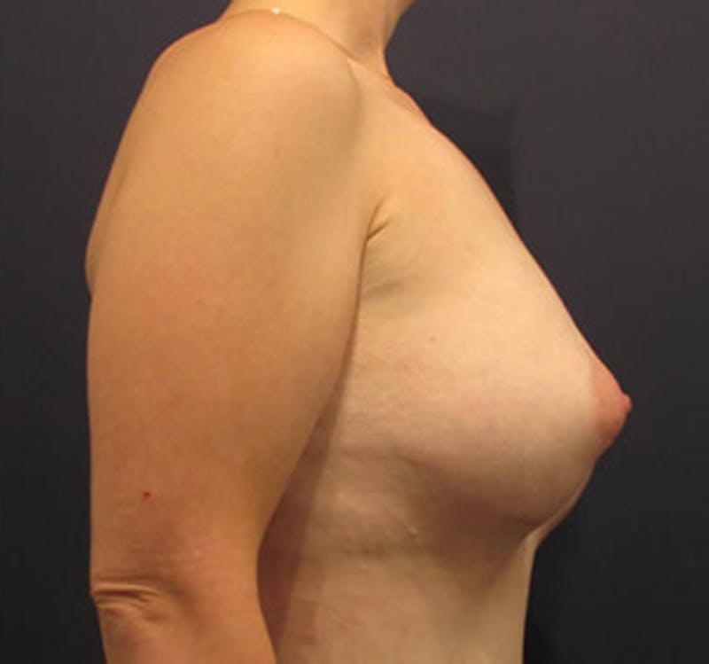 Breast Augmentation Before & After Gallery - Patient 174160967 - Image 6