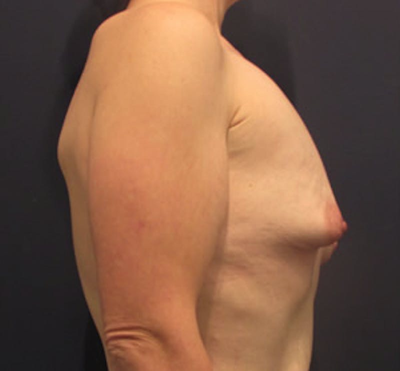 Breast Augmentation Before & After Gallery - Patient 174160967 - Image 5