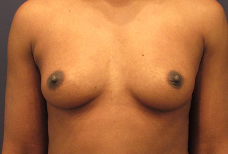 Breast Augmentation Before & After Gallery - Patient 174162058 - Image 1