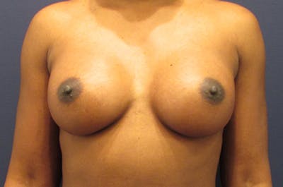 Breast Augmentation Before & After Gallery - Patient 174162058 - Image 2