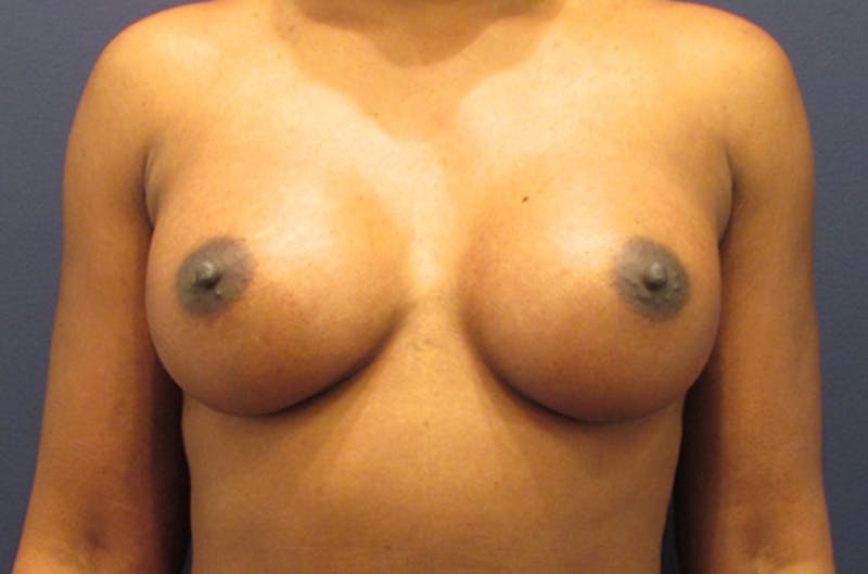 Breast Augmentation Before & After Gallery - Patient 174162058 - Image 2