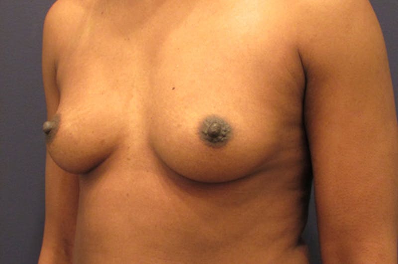 Breast Augmentation Before & After Gallery - Patient 174162058 - Image 3