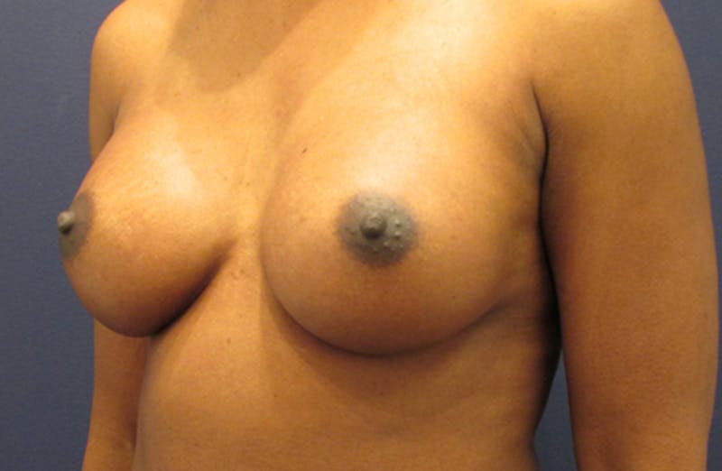 Breast Augmentation Before & After Gallery - Patient 174162058 - Image 4