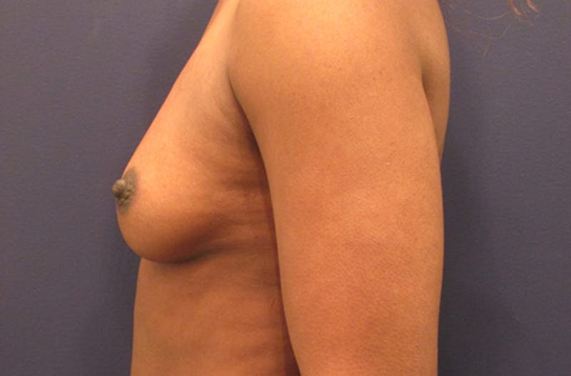 Breast Augmentation Before & After Gallery - Patient 174162058 - Image 5