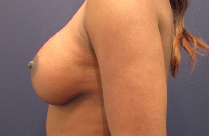 Breast Augmentation Before & After Gallery - Patient 174162058 - Image 6