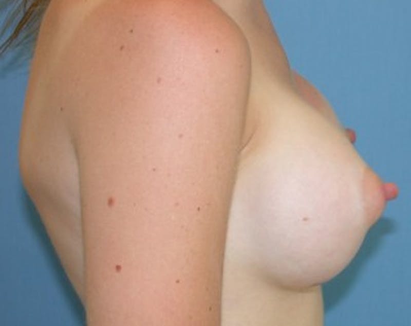 Breast Augmentation Before & After Gallery - Patient 174162071 - Image 4