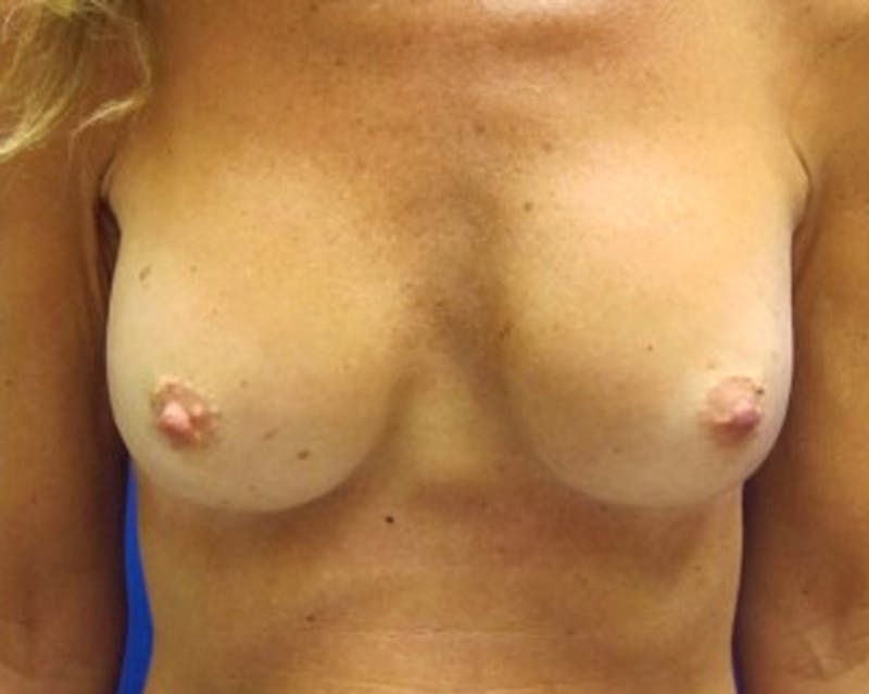 Breast Augmentation Before & After Gallery - Patient 174163155 - Image 2