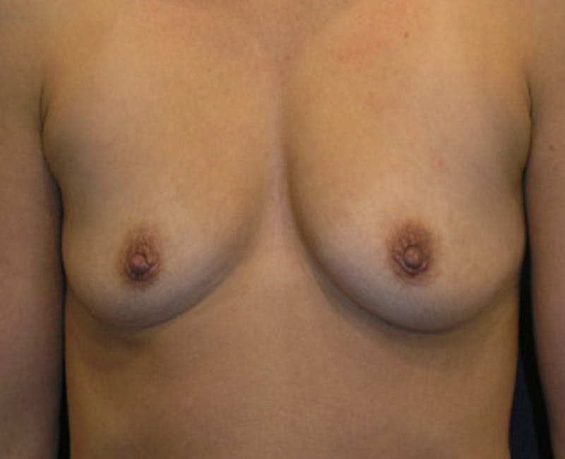 Breast Augmentation Before & After Gallery - Patient 174163169 - Image 1
